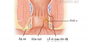 Biến chứng của apxe hậu môn