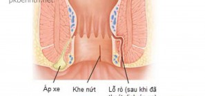 Áp xe hậu môn là gì?