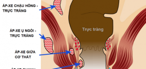 Nguyên nhân áp xe hậu môn