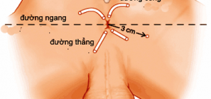 Điều trị bệnh Rò Hậu Môn