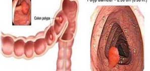 Polyp hậu môn và triệu chứng polyp hậu môn